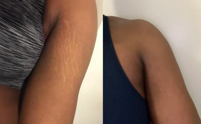 Skin transformation