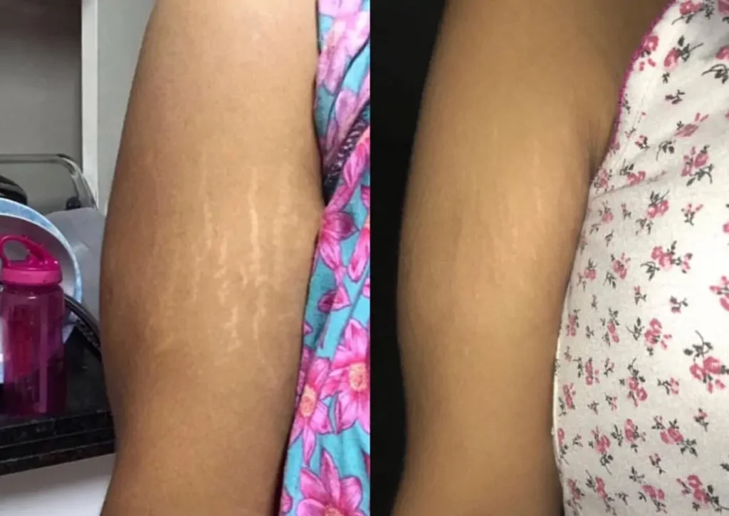 Stretch mark result