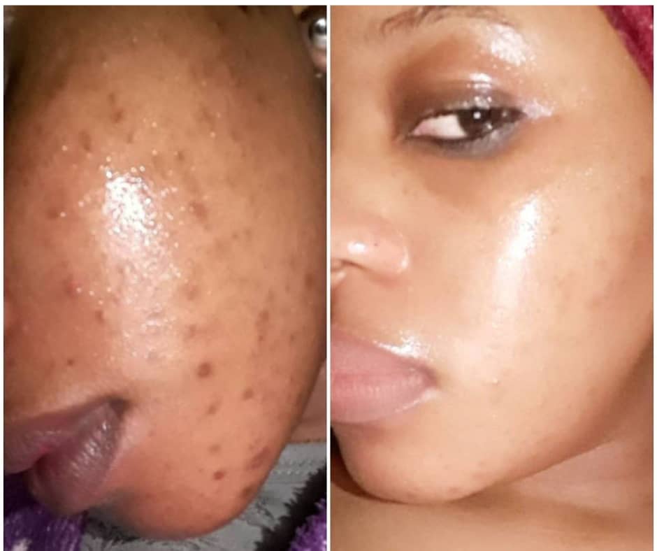 Acne and dark spots treated