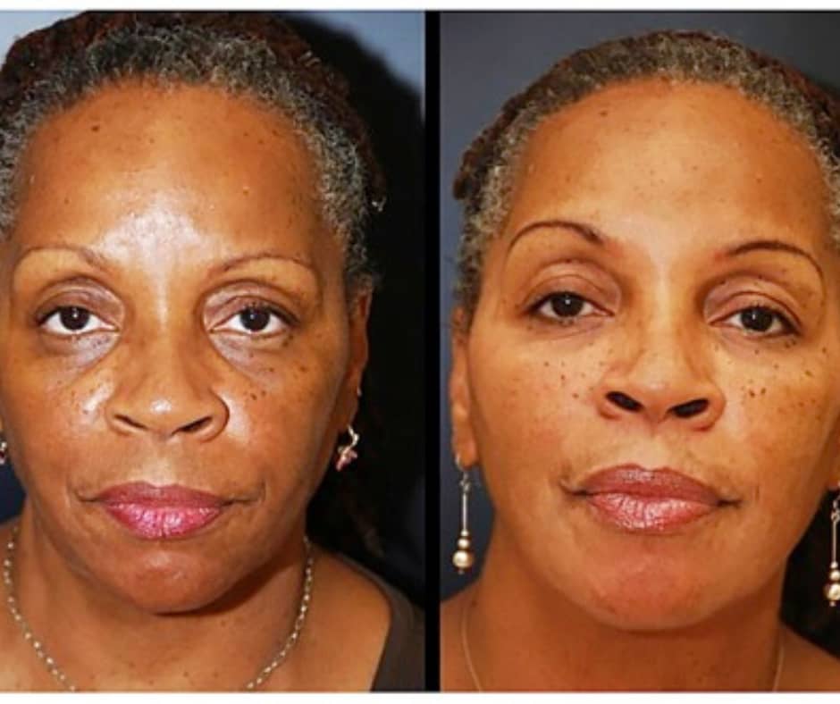 LED mask - before and after