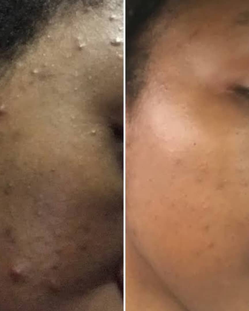 Skin transformation