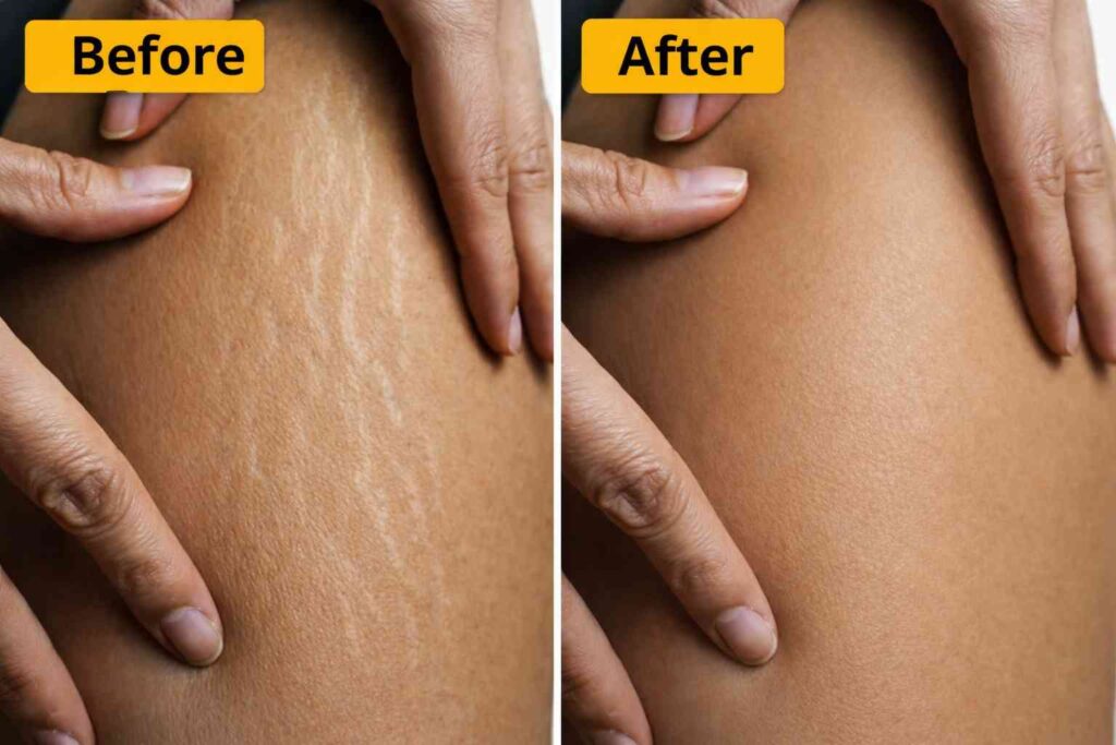 Stretch marks before and after