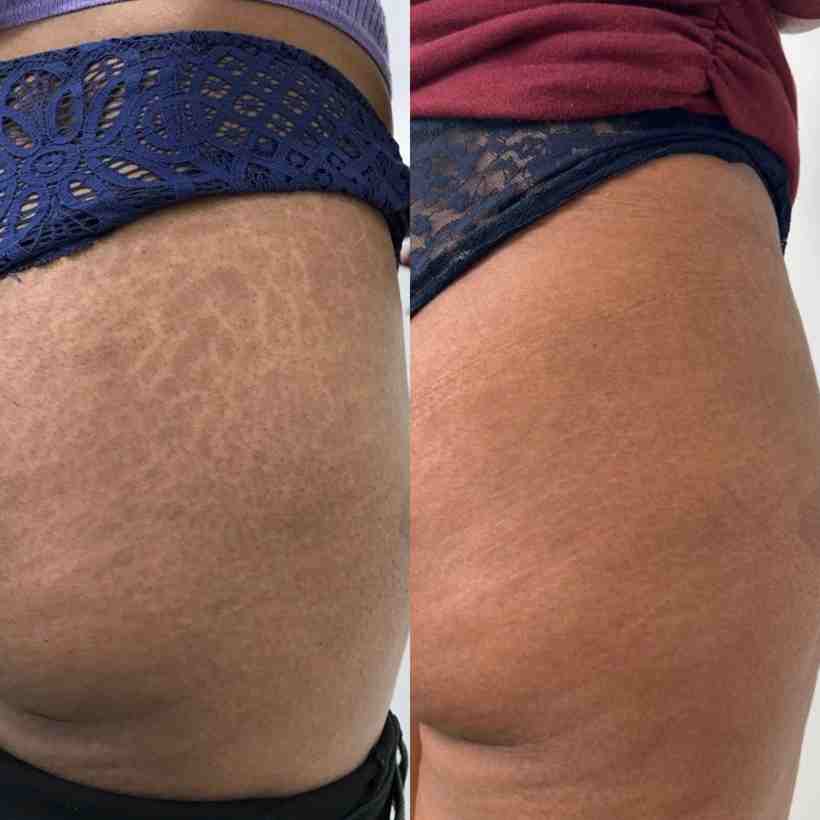 Stretch marks treatment